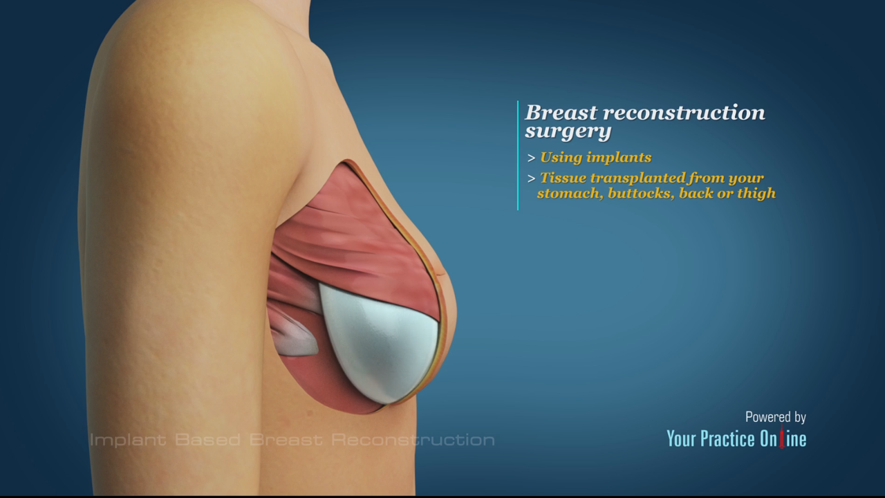 Breast prosthesis reconstruction