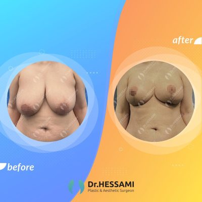 Reduction mammoplasty in Iran