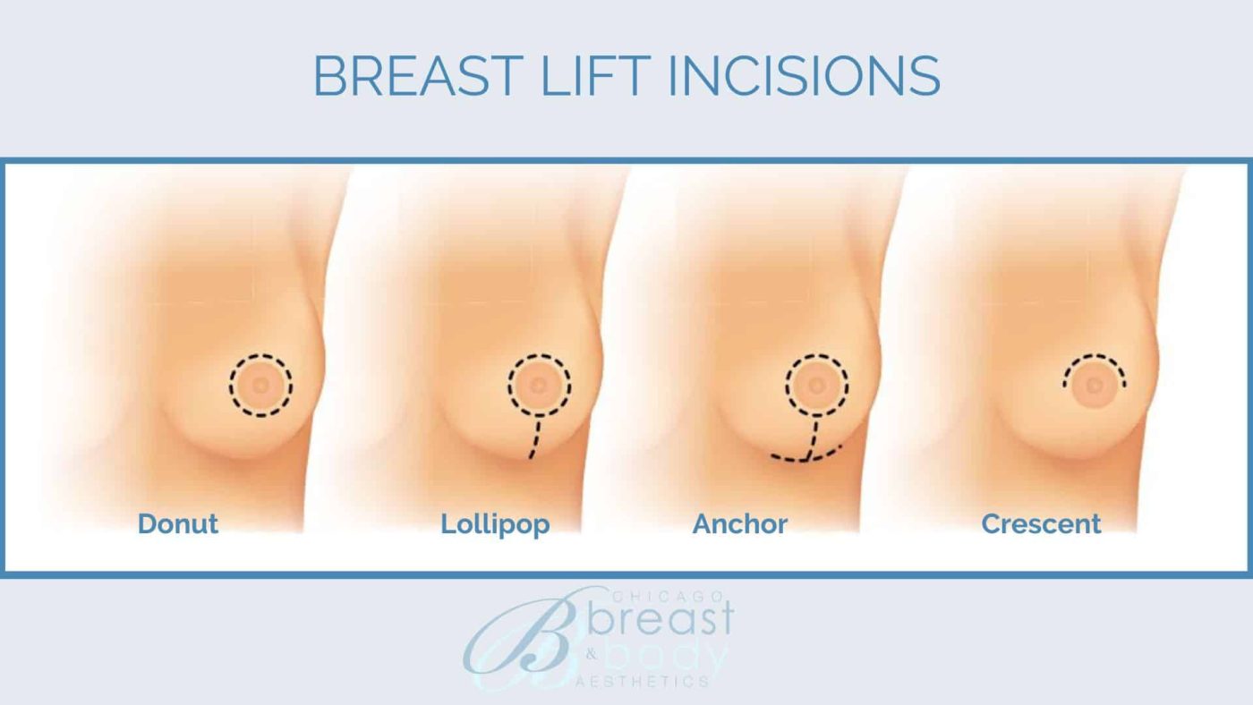 Breast lift surgery in Iran