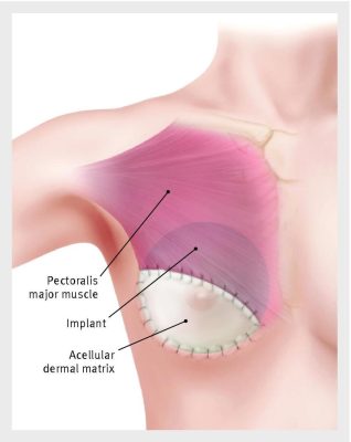 Breast prosthesis reconstruction