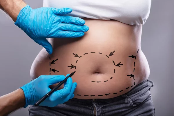 Abdominal plastic surgery in Iran