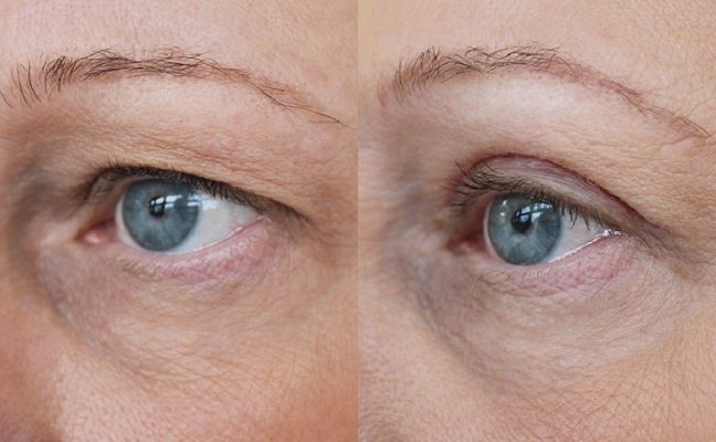 Blepharoplasty in Iran