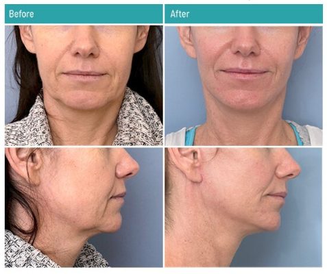 Facelift surgery in Iran
