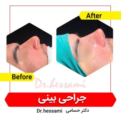 rhinoplasty in Iran