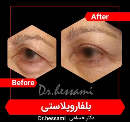 Blepharoplasty in Iran - eyelid surgery