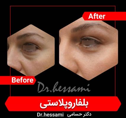 Blepharoplasty in Iran - eyelid surgery