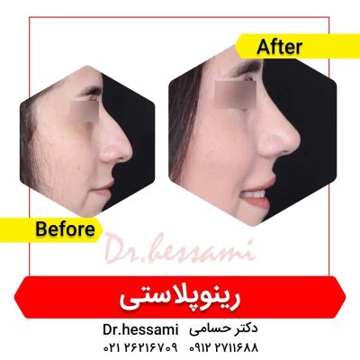 rhinoplasty in Iran