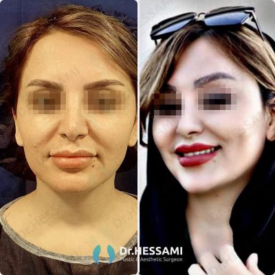 lip lift surgery in Iran