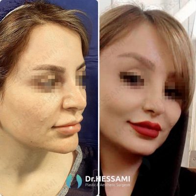 lip lift surgery in Iran
