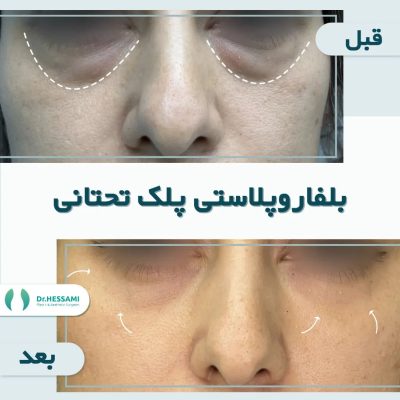 Lower blepharoplasty in Iran