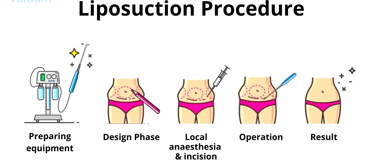 The best liposuction surgeon in Iran
