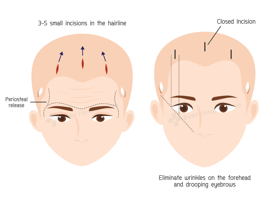 best endoscopic forehead lift surgeon in Iran