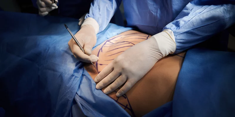 best abdominoplasty surgeon in Iran