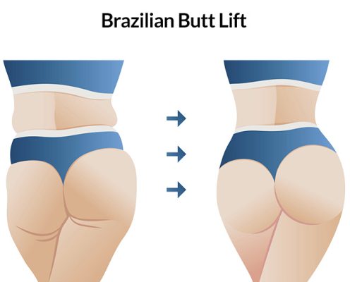 The best Brazilian butt lift surgeon in Iran