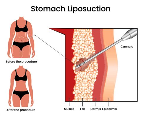 Liposuction in Iran