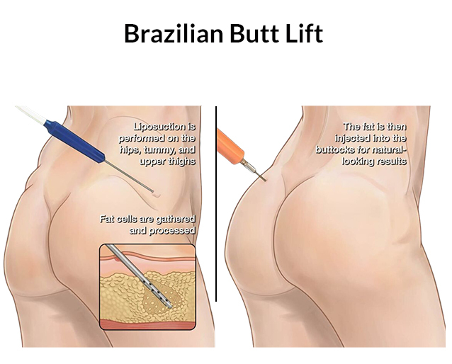 The best Brazilian but lift surgeon in Iran