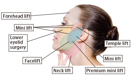 Facelift surgery in Iran 