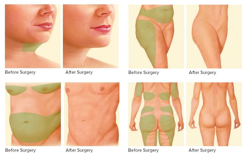 Reconstructive liposuction in Iran