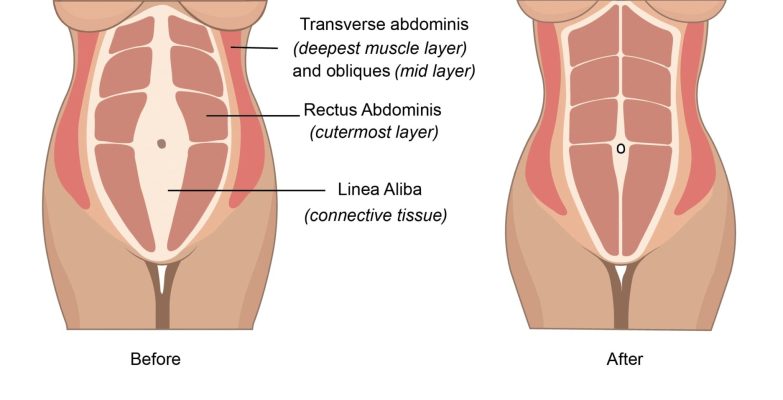 Tummy tuck in Iran