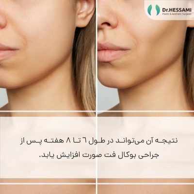 Buccal fat removal in Iran