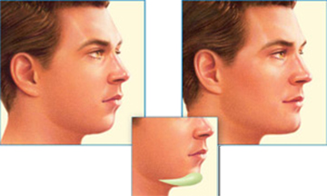 Chin prosthesis surgery in Iran