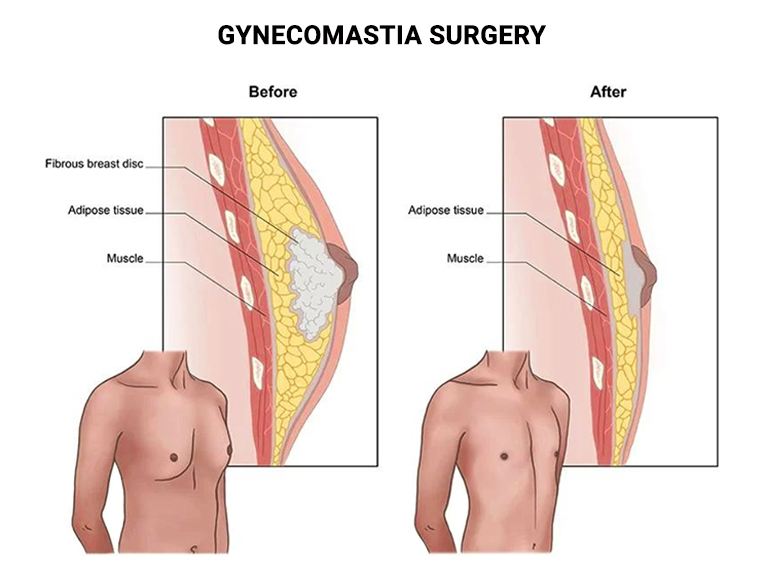 Gynecomastia in Iran - Male Breast Reduction