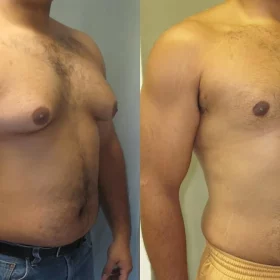 Gynecomastia in Iran - Male Breast Reduction