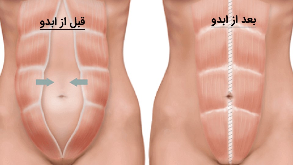 Abdominal liposuction in Iran