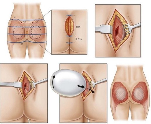 Buttock prosthesis surgery in Iran