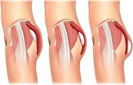 Buttock prosthesis surgery in Iran