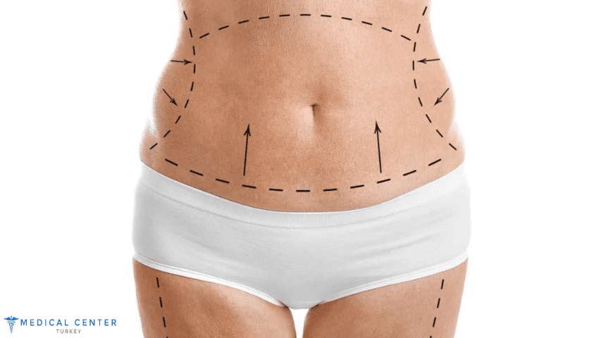 J Plasme vs Abdominoplasty - Renuvion in Iran