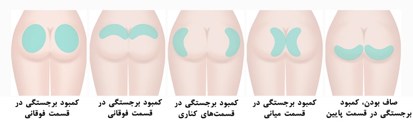 Buttock augmentation in Iran