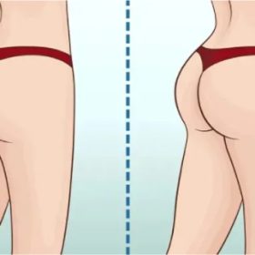 Buttock augmentation in Iran