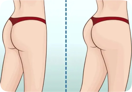 Buttock augmentation in Iran